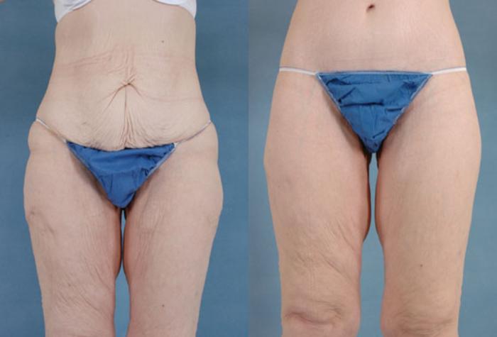 Before & After Body Lift after massive weight loss Case 88 View #2 View in Tallahassee, FL