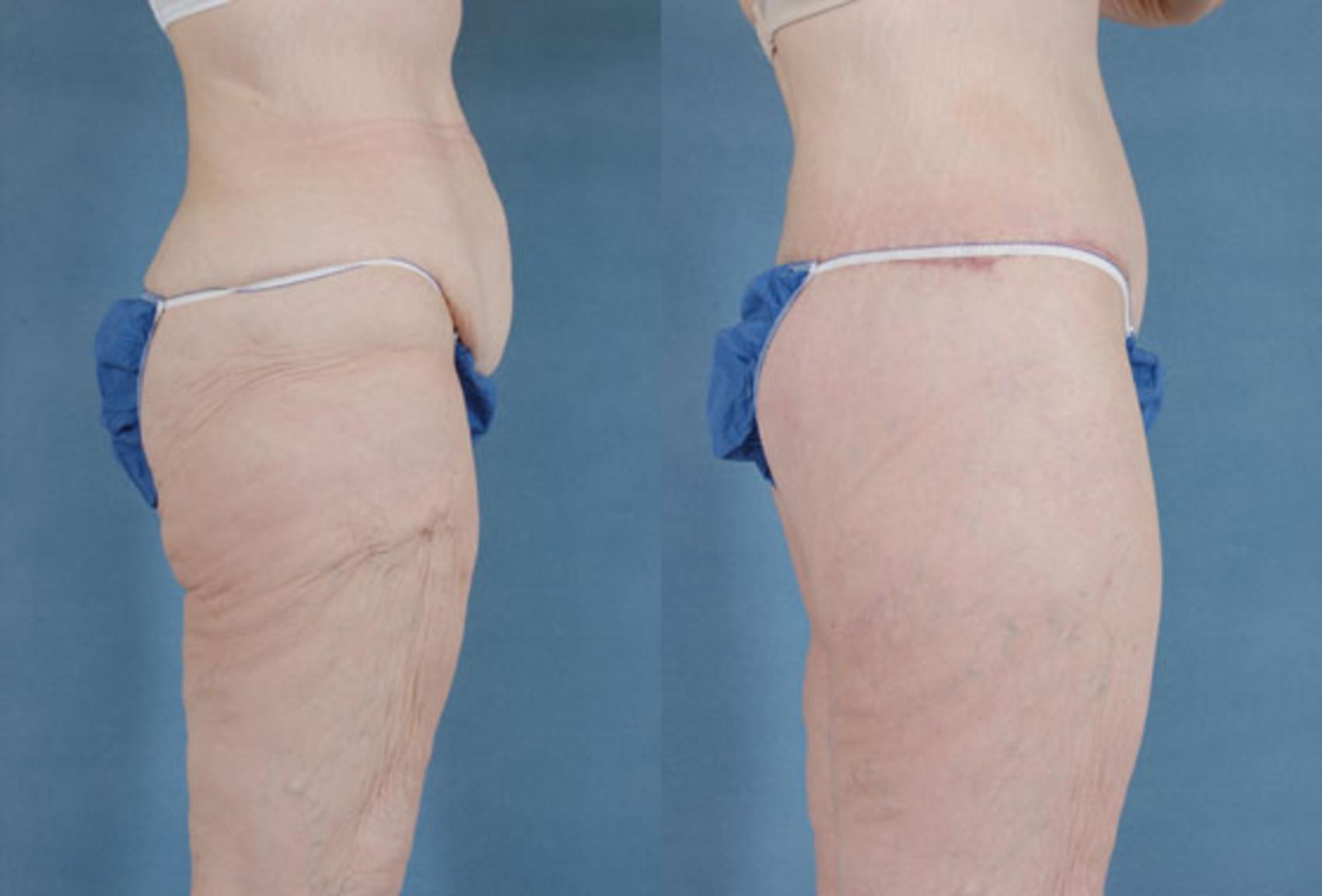Before & After Body Lift after massive weight loss Case 88 View #3 View in Tallahassee, FL