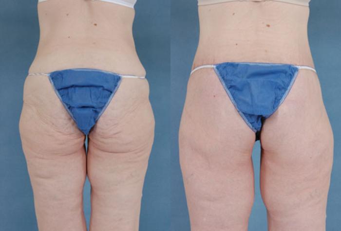 Before & After Body Lift after massive weight loss Case 88 View #4 View in Tallahassee, FL