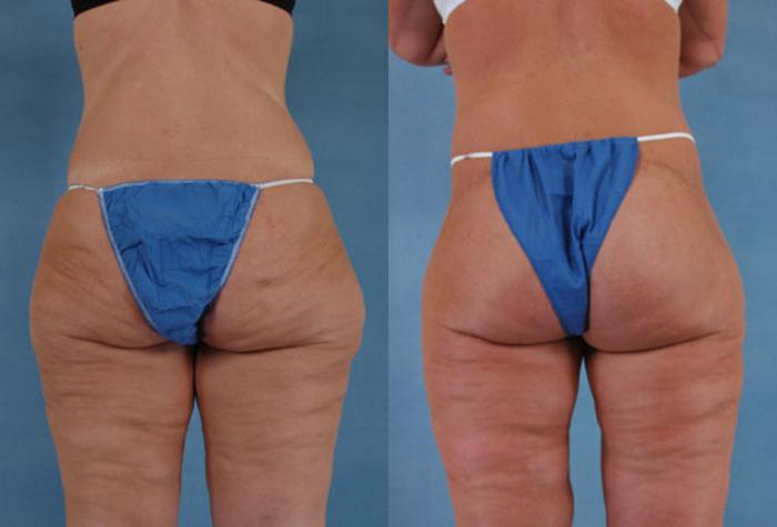 Before & After Body Lift after massive weight loss Case 89 View #3 View in Tallahassee, FL