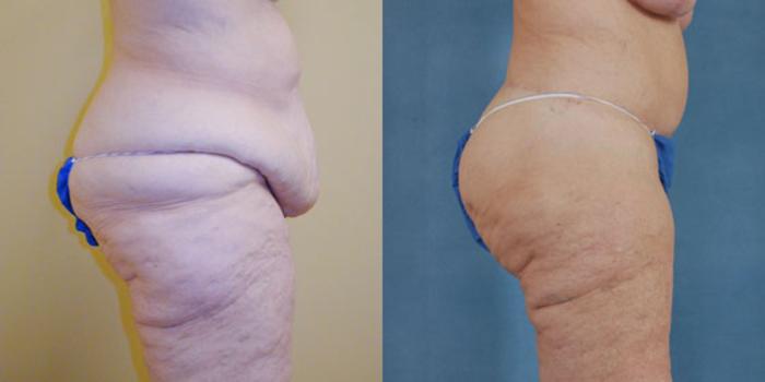 Before & After Body Lift after massive weight loss Case 91 View #2 View in Tallahassee, FL