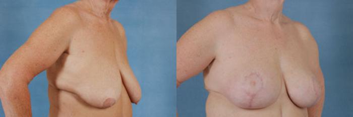 Before & After Body Lift after massive weight loss Case 91 View #4 View in Tallahassee, FL