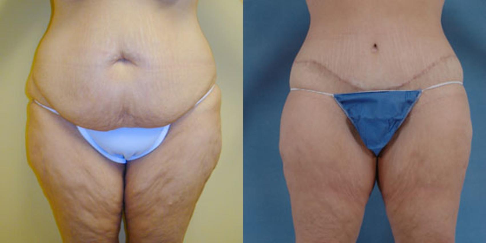 Before & After Body Lift after massive weight loss Case 92 View #1 View in Tallahassee, FL