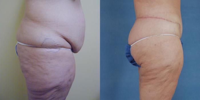 Before & After Body Lift after massive weight loss Case 92 View #2 View in Tallahassee, FL