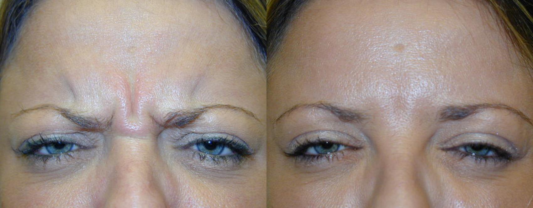 Before & After Botox/Dysport Case 251 View #1 View in Tallahassee, FL