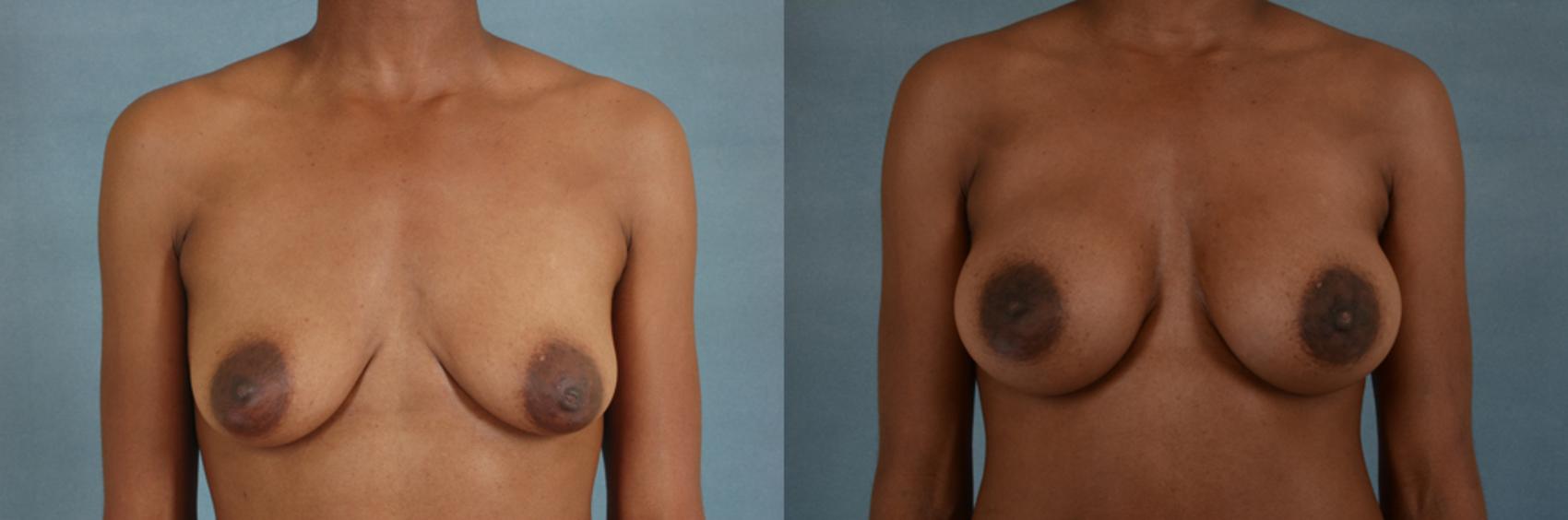 Before & After Breast Augmentation Case 187 View #1 View in Tallahassee, FL