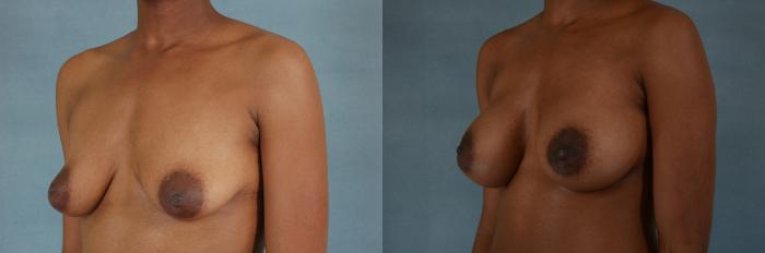 Before & After Breast Augmentation Case 187 View #2 View in Tallahassee, FL