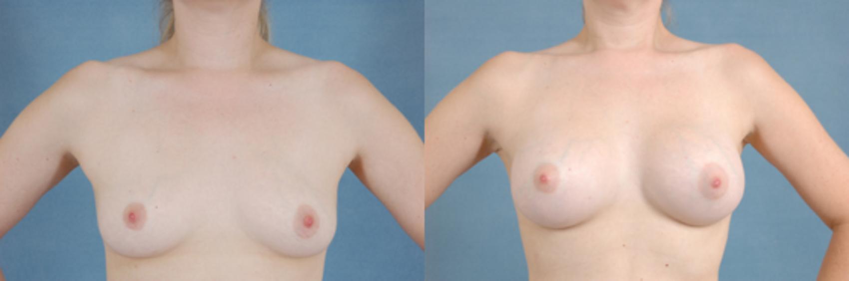 Before & After Breast Augmentation Case 188 View #1 View in Tallahassee, FL