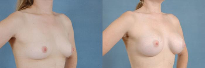 Before & After Breast Augmentation Case 188 View #2 View in Tallahassee, FL