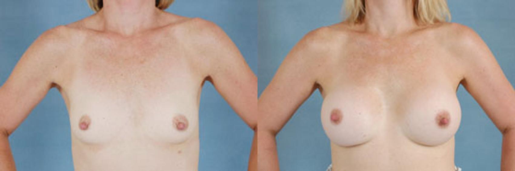 Before & After Breast Augmentation Case 189 View #1 View in Tallahassee, FL
