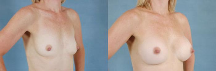 Before & After Breast Augmentation Case 189 View #2 View in Tallahassee, FL