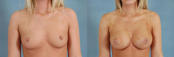 Before & After Breast Augmentation Case 190 View #1 View in Tallahassee, FL