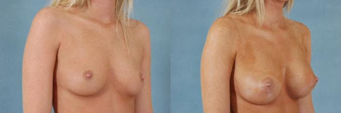 Before & After Breast Augmentation Case 190 View #2 View in Tallahassee, FL