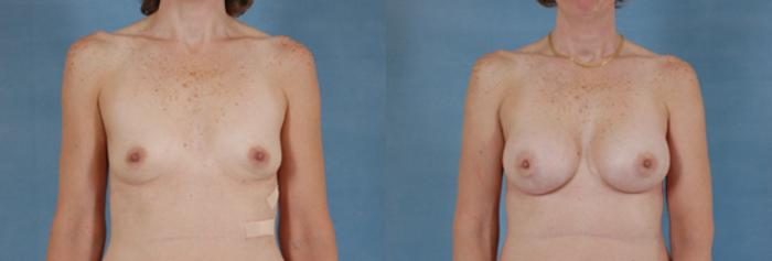 Before & After Breast Augmentation Case 191 View #1 View in Tallahassee, FL