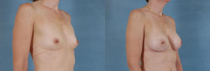 Before & After Breast Augmentation Case 191 View #2 View in Tallahassee, FL
