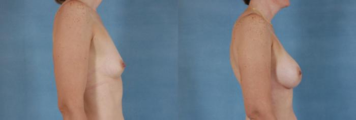 Before & After Breast Augmentation Case 191 View #3 View in Tallahassee, FL