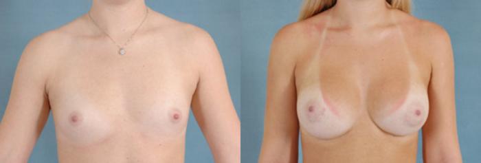 Before & After Breast Augmentation Case 193 View #1 View in Tallahassee, FL