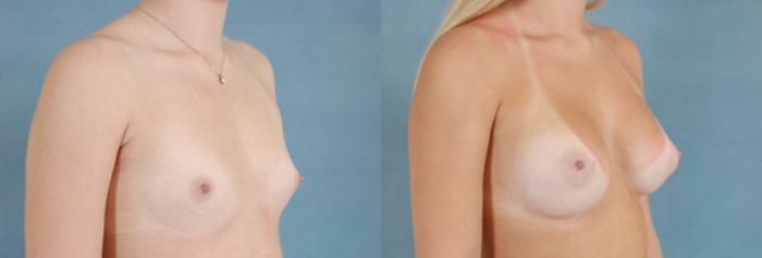 Before & After Breast Augmentation Case 193 View #2 View in Tallahassee, FL