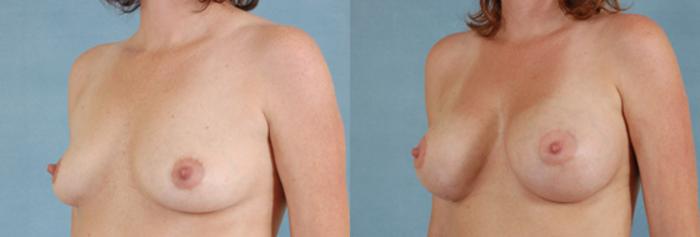 Before & After Breast Augmentation Case 195 View #2 View in Tallahassee, FL