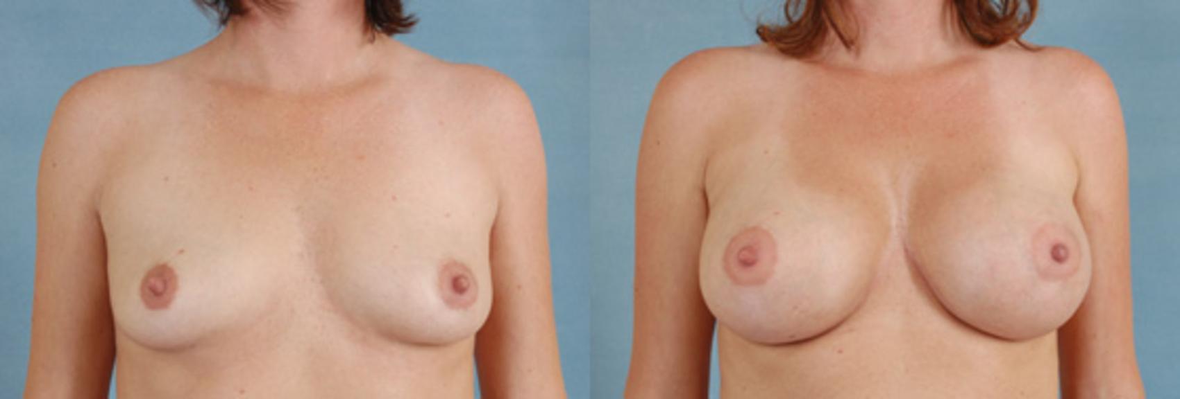 Before & After Breast Augmentation Case 196 View #1 View in Tallahassee, FL