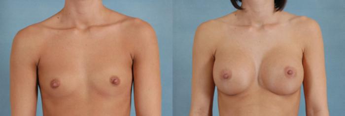 Before & After Breast Augmentation Case 197 View #1 View in Tallahassee, FL