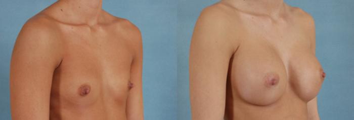 Before & After Breast Augmentation Case 197 View #2 View in Tallahassee, FL