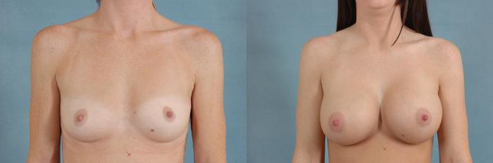 Before & After Breast Augmentation Case 198 View #1 View in Tallahassee, FL