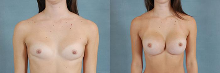 Before & After Breast Augmentation Case 199 View #1 View in Tallahassee, FL