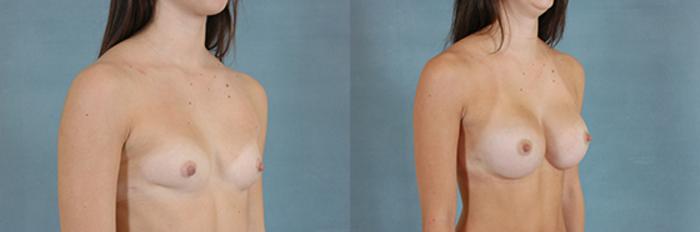 Before & After Breast Augmentation Case 199 View #2 View in Tallahassee, FL