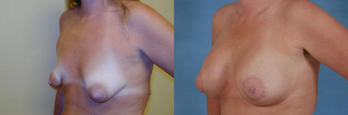 Before & After Breast Augmentation Case 200 View #5 View in Tallahassee, FL