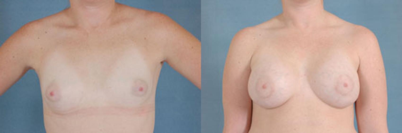 Before & After Breast Augmentation Case 201 View #1 View in Tallahassee, FL