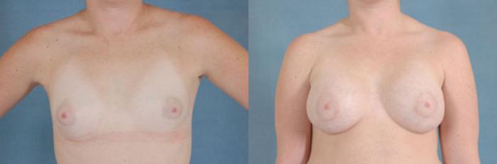 Before & After Breast Augmentation Case 201 View #1 View in Tallahassee, FL