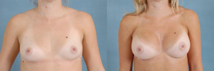 Before & After Breast Augmentation Case 202 View #1 View in Tallahassee, FL