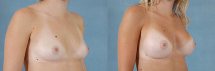 Before & After Breast Augmentation Case 202 View #2 View in Tallahassee, FL