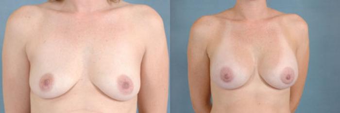 Before & After Breast Augmentation Case 203 View #1 View in Tallahassee, FL