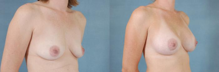 Before & After Breast Augmentation Case 203 View #2 View in Tallahassee, FL