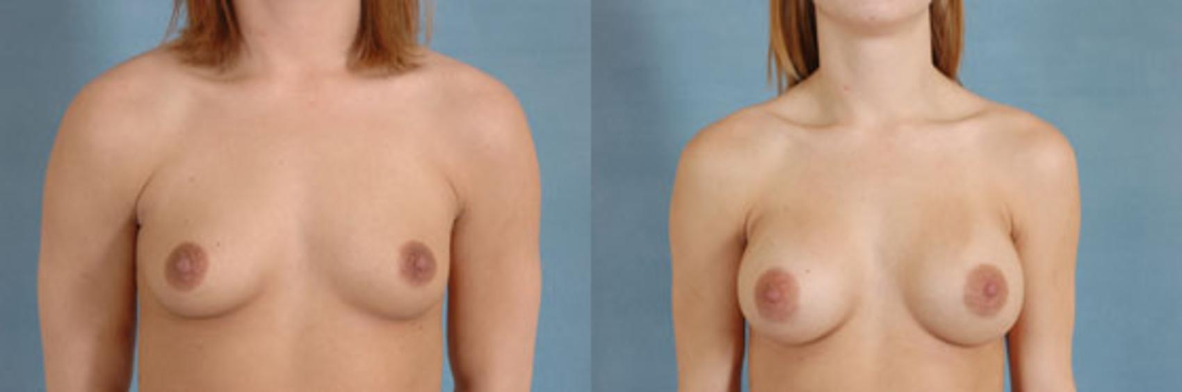 Before & After Breast Augmentation Case 204 View #1 View in Tallahassee, FL