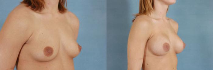 Before & After Breast Augmentation Case 204 View #2 View in Tallahassee, FL
