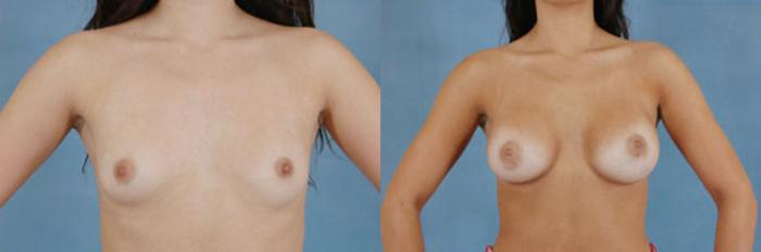 Before & After Breast Augmentation Case 205 View #1 View in Tallahassee, FL
