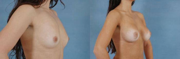 Before & After Breast Augmentation Case 205 View #2 View in Tallahassee, FL
