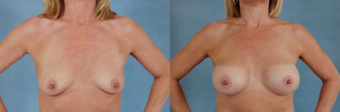 Before & After Breast Augmentation Case 206 View #1 View in Tallahassee, FL