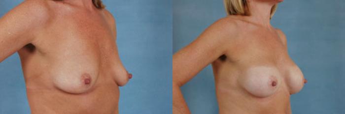 Before & After Breast Augmentation Case 206 View #2 View in Tallahassee, FL