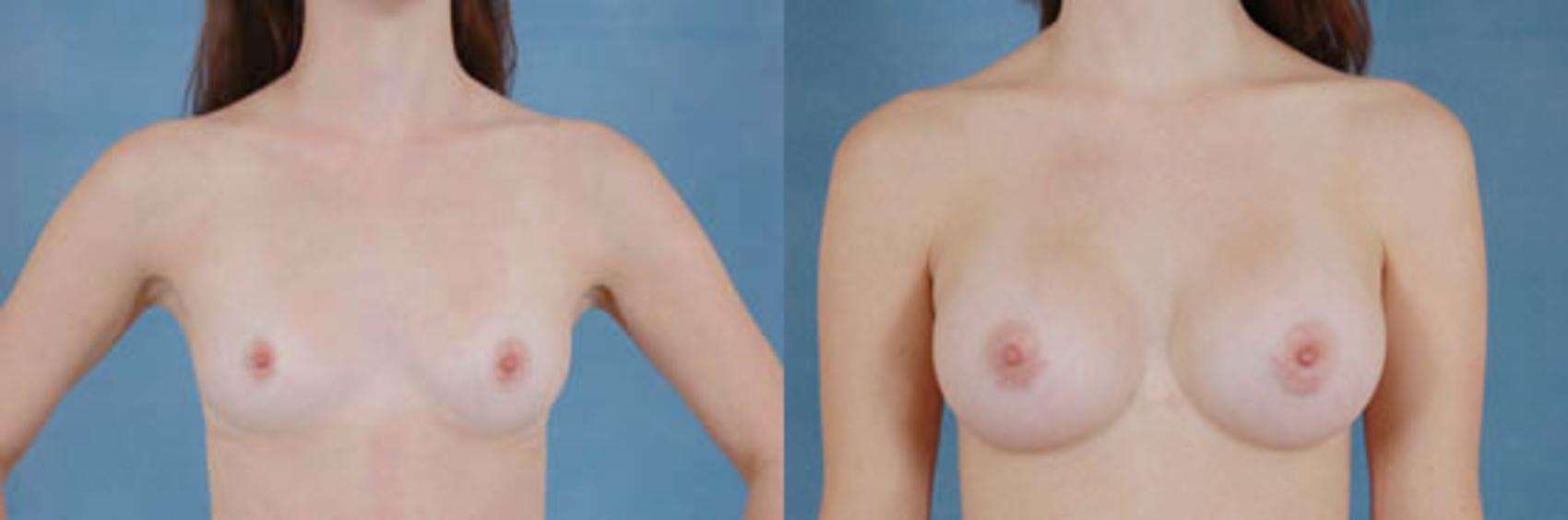 Before & After Breast Augmentation Case 207 View #1 View in Tallahassee, FL