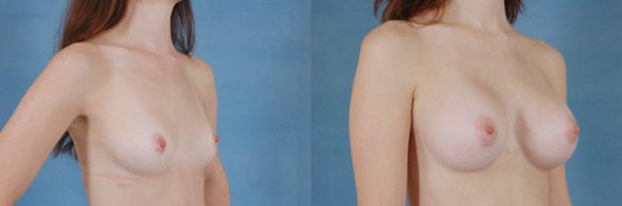 Before & After Breast Augmentation Case 207 View #2 View in Tallahassee, FL