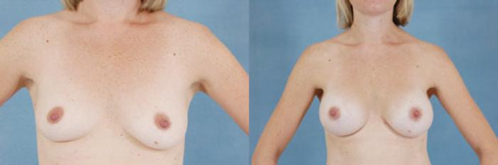 Before & After Breast Augmentation Case 208 View #1 View in Tallahassee, FL