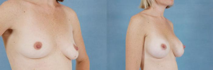 Before & After Breast Augmentation Case 208 View #2 View in Tallahassee, FL