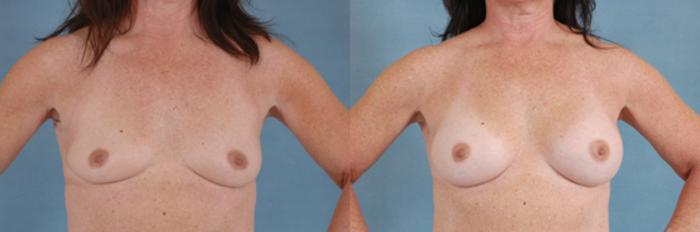 Before & After Breast Augmentation Case 209 View #1 View in Tallahassee, FL