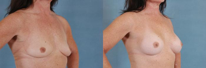 Before & After Breast Augmentation Case 209 View #2 View in Tallahassee, FL