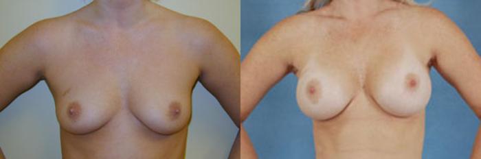 Before & After Breast Augmentation Case 210 View #1 View in Tallahassee, FL