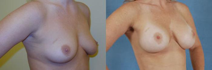 Before & After Breast Augmentation Case 210 View #2 View in Tallahassee, FL